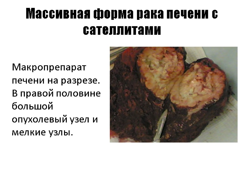 Массивная форма рака печени с сателлитами   Макропрепарат печени на разрезе. В правой